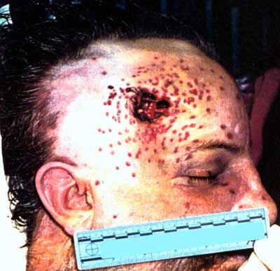 Figure 11 is a photograph showing a wound caused by a flare gun.