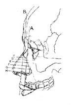 The soft tissue of a face, head, and nose superimposed on a skull with lines drawn to indicate how reconstruction was developed.