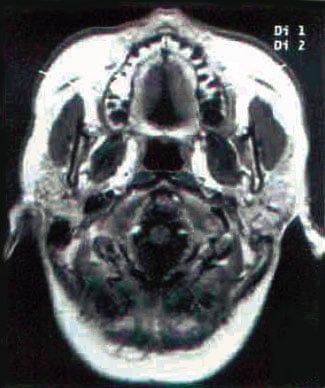 A graphic profile of a parasagittal section of a skull at the midorbit right frontal eminence.