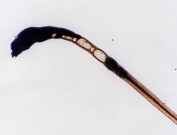 Figure 74 is a photomicrograph of burned hair.