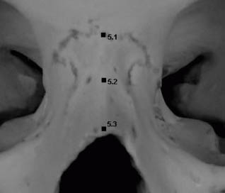 Representation of landmarks on the nasal bone: nasion, midnasal, rhinion.