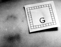 Photograph showing a bite mark on skin with a paper scale placed alongside the bite mark.