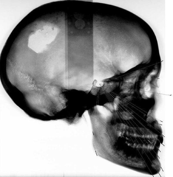 Large size of Figure 3. Lateral cephalograph of the project skull (negative). The black markers show the predicted profile growth pattern and indicate the alteration during the adult years of life.