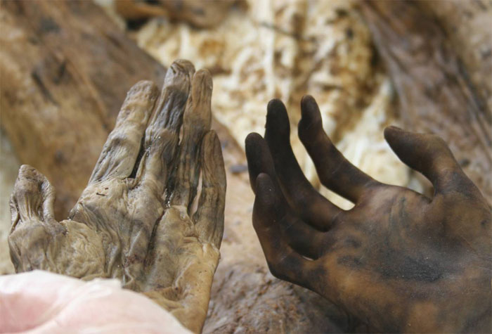 Figure 6 shows left and right hands, both exposed in the same environmental conditions, from a body recovered after the December 2004 South Asian tsunami. The hands prior to boiling were macerated, exhibiting wrinkles and no visible friction ridge detail (left hand). The hands after boiling were reconditioned, exhibiting visible friction ridge detail and no wrinkles (right hand).