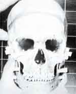 Graphic image of the skull associated with the 1990 FBI case