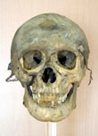 Photograph of naturally mummified skeleton (front view) of Anital Simon found in Hungary in the mid-1990s.