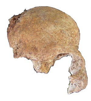 Figure 6. Frontal or Anterior of the Same Cranial Fragment after the Background Was â€œErasedâ€ Using Photoshop
